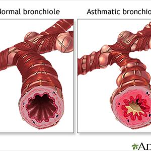Cure For Bronchitis - Some Medicine That Will Help Fight Bronchitis