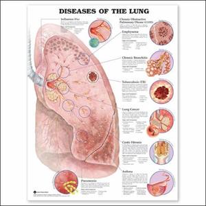 Chronic Soar Throat And Bronchitis 