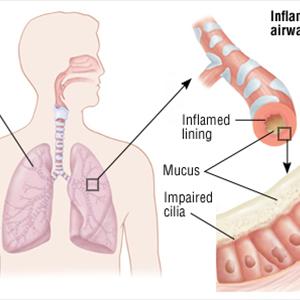 Cure Bacterial Bronchitis - COPD: Treating Longterm Obstructive Pulmonary Disease