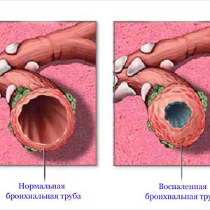 Prednisone Treatment For Bronchitis - Acute Bronchitis Symptoms: Cough, A Fever, Chest Pain, & More