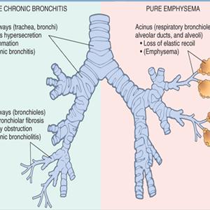 Phlemn - Brochitis Disease