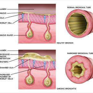 Holistic Remedies For Bronchitis 