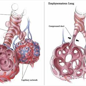 Wheezing Lungs Chest Months - How Could A Lung Detox Help Smokers?