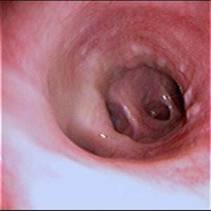 Antibiotics For Bronch - Boost Lung And Nasal Health With Pleurisy Root