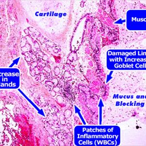  Types Of Lung Cancer