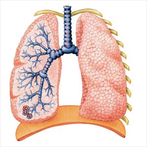 Coughing Up Thick White Phlegm - Bronchitis Organization And Information To Manage This Disorder