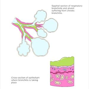 Herbel Treatment For Bacterial Brochitis - Are E Cigarettes Safer Than Regular Cigarettes?