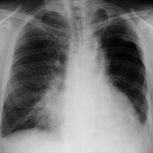  Industrial Illness Claims With Regard To Black Lung Disease