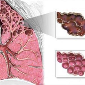 Acute Bronchitis Natural Treatment 