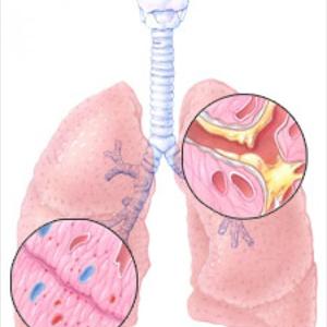 Bronchitis Cough - Alternative Emphysema Treatment