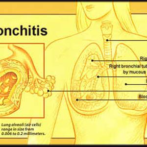  Bronchitis Therapeutics 