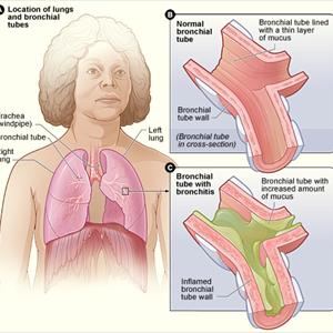 Puffers For Bronchitis - Bronchitis Firm And Information To Manage This Disorder