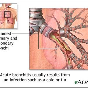 Bronchitis Cough Remedies 