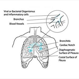 Bronchitis Disease - Home Remedies With Regard To Bronchitis Relief