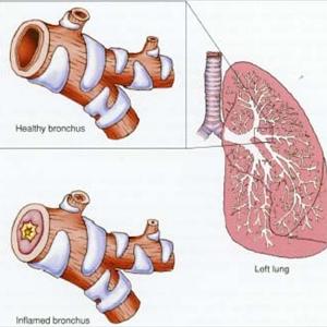 Does Penicilin Cure Bronchitis - Lung Detoxification Will Help You Give Up Smoking