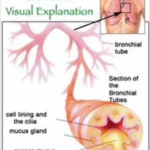 Is Bronchitis Contagious - Air Pollution