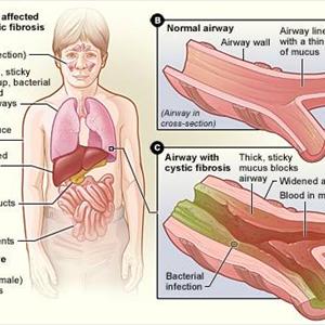Clear Lungs For Bronchitis - Chronic Cough Causes, Signs And Symptoms And Treatment