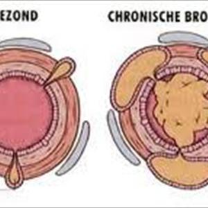  Types Of Lung Cancer