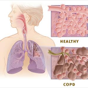 Chronic Bronchitis Cure - How Secondhand Smoke Threatens Your Health