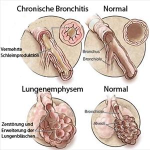 Mucus Plug In Lungs 