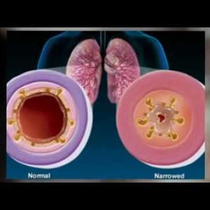 Does Penicilin Cure Bronchitis - Lung Detoxification Will Help You Give Up Smoking