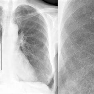 Medicine For Bronchitis Cough - What Is A Lung Detox Regarding Smokers?