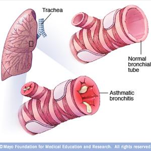 Pot Smokers Phelm Cough - Bronchitis In The Course Of Pregnancy