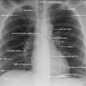 Alternative Cures For Bronchitis 