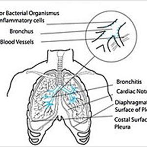 Bronchitis Spreadable 
