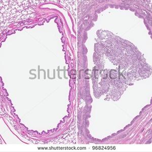  Ways To Monitor Lower Emphysema