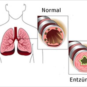 Cure Bacterial Bronchitis - COPD: Treating Persistent Obstructive Lung Disease