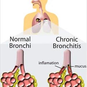 Bronchitis Specialist Doctor - Diagnosis As Well As Treating Acute Bronchitis In Adults