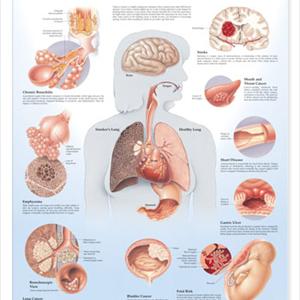Holistic Remedies For Bronchitis - Bronchitis- Severe Bronchitis